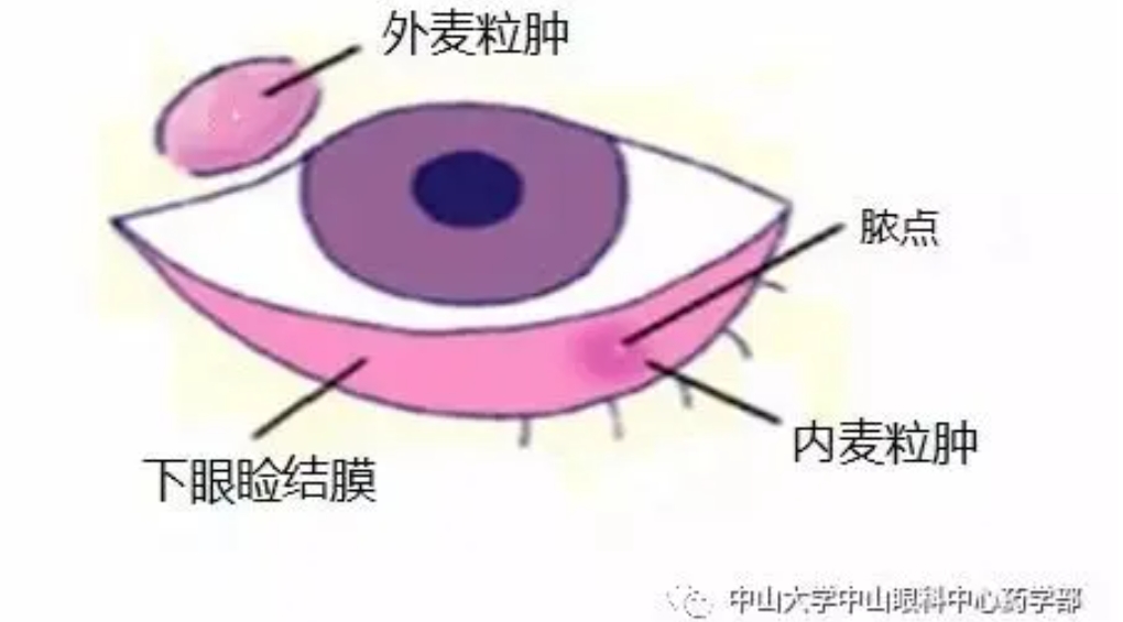 麦粒肿