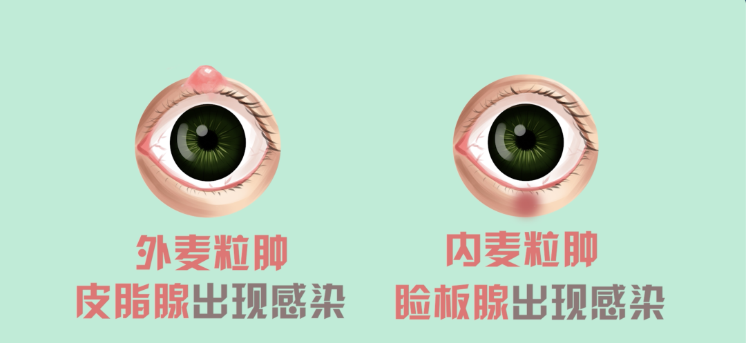 麦粒肿